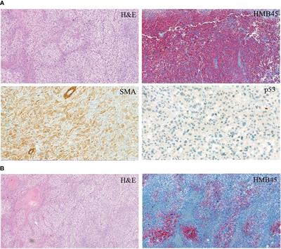 Case Report: A Novel Pathomechanism in PEComa by the Loss of Heterozygosity of TP53